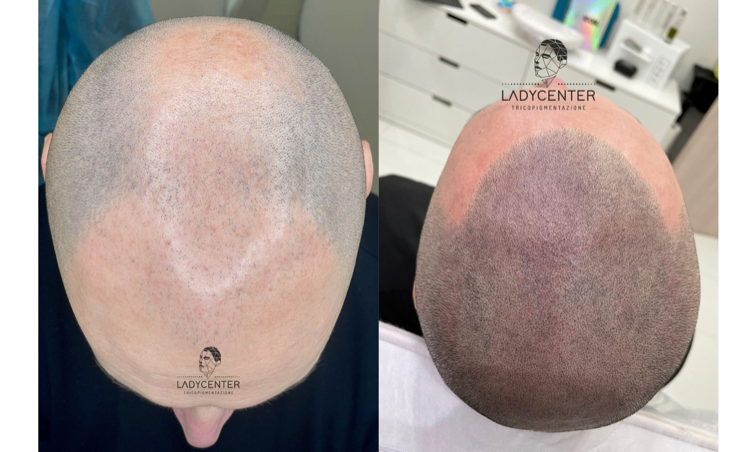 Prima e dopo tre sedute di trattamento.