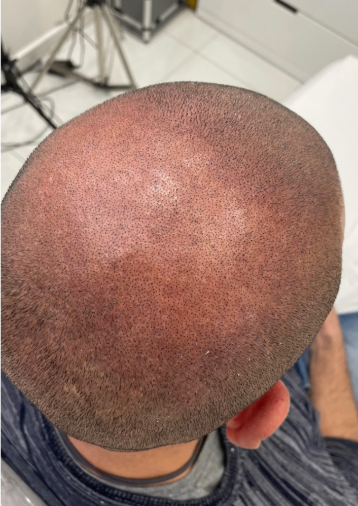 tricopigmentazione effetto rasato vertex prima seduta