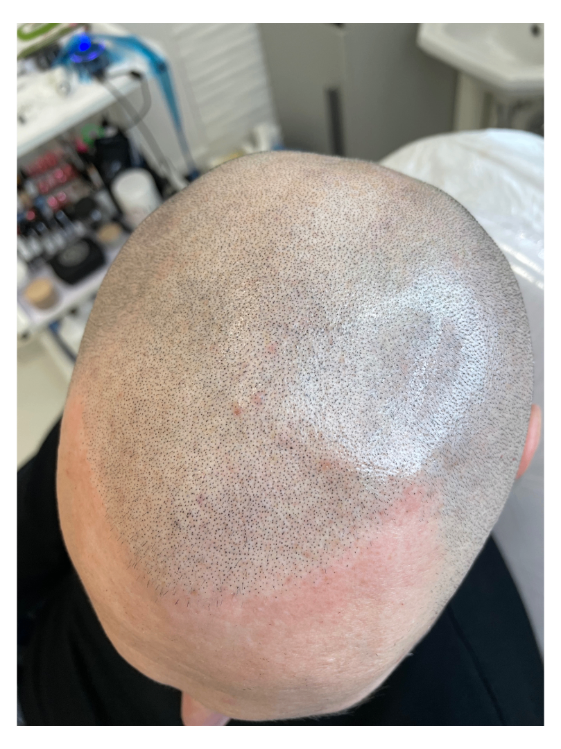 tricopigmentazione effetto rasato cuoio capelluto effetto densità