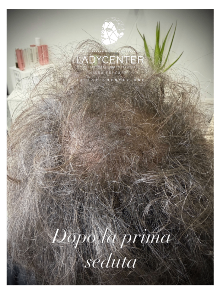 tricopigmentazione vertex chierica effetto densità