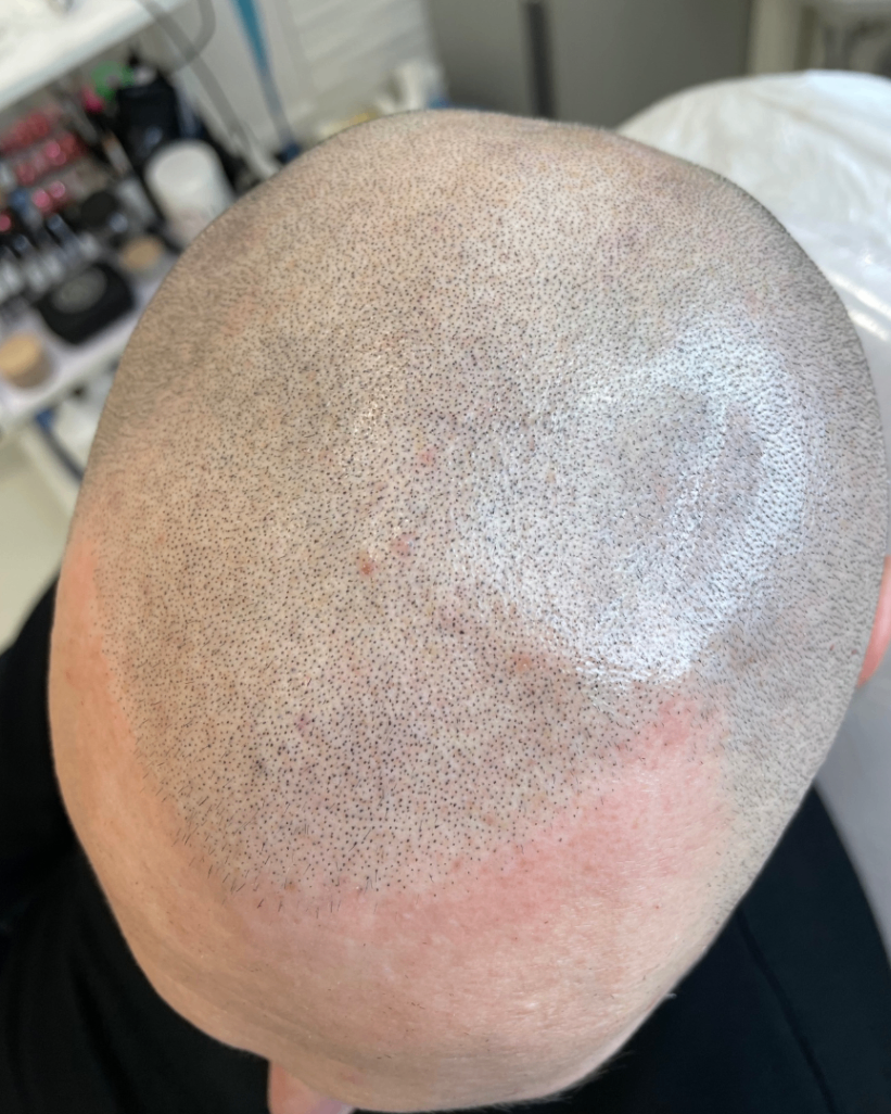 tricopigmentazione effetto rasato seconda seduta