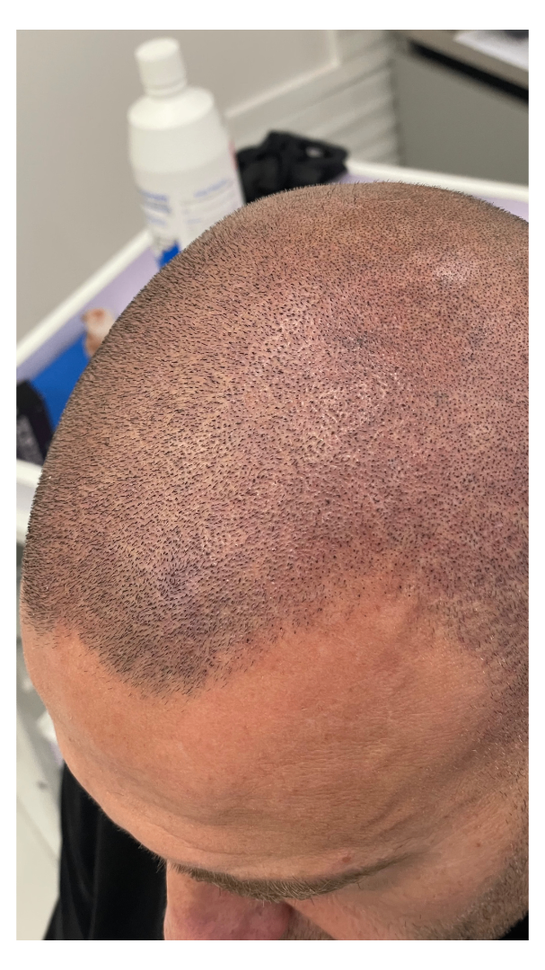 tricopigmentazione effetto rasato cuoio capelluto effetto densità