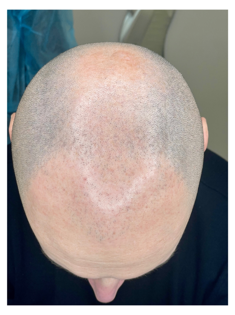 tricopigmentazione effetto rasato cuoio capelluto effetto densità