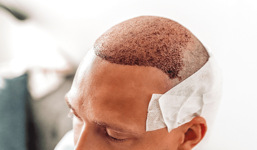 auto trapianto di capelli