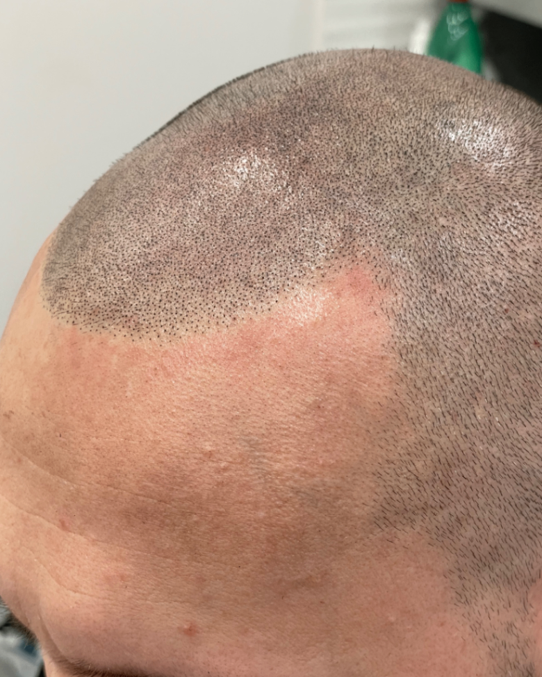 tricopigmentazione effetto rasato terza seduta