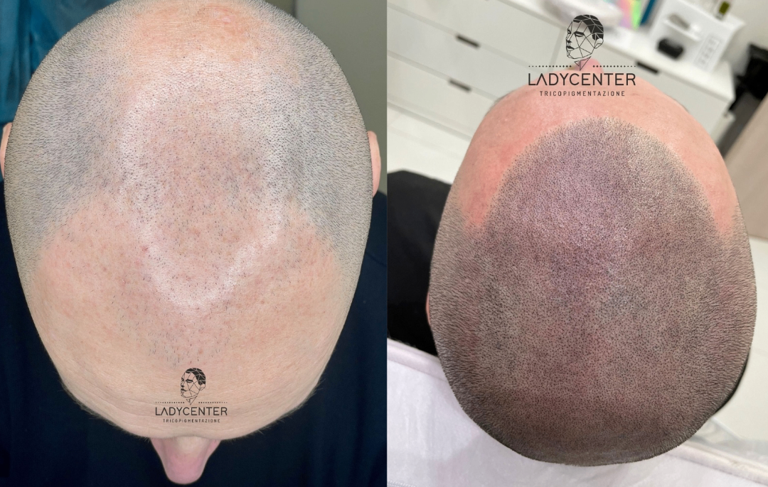 tricopigmentazione effetto rasato