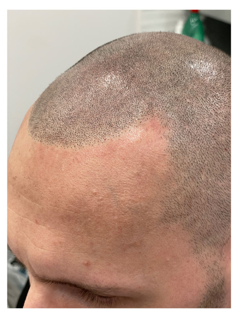 tricopigmentazione effetto rasato cuoio capelluto effetto densità