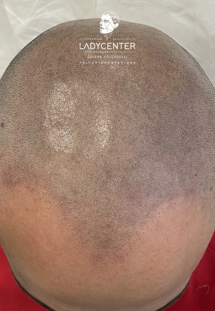 tricopigmentazione effetto rasato del cuoio capelluto