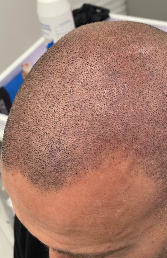 tricopigmentazione effetto rasato seconda seduta riempimento zona tempie e vertex