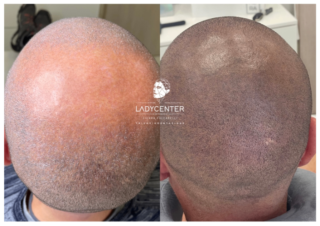 tricopigmentazione effetto rasato cuoio capelluto effetto densità