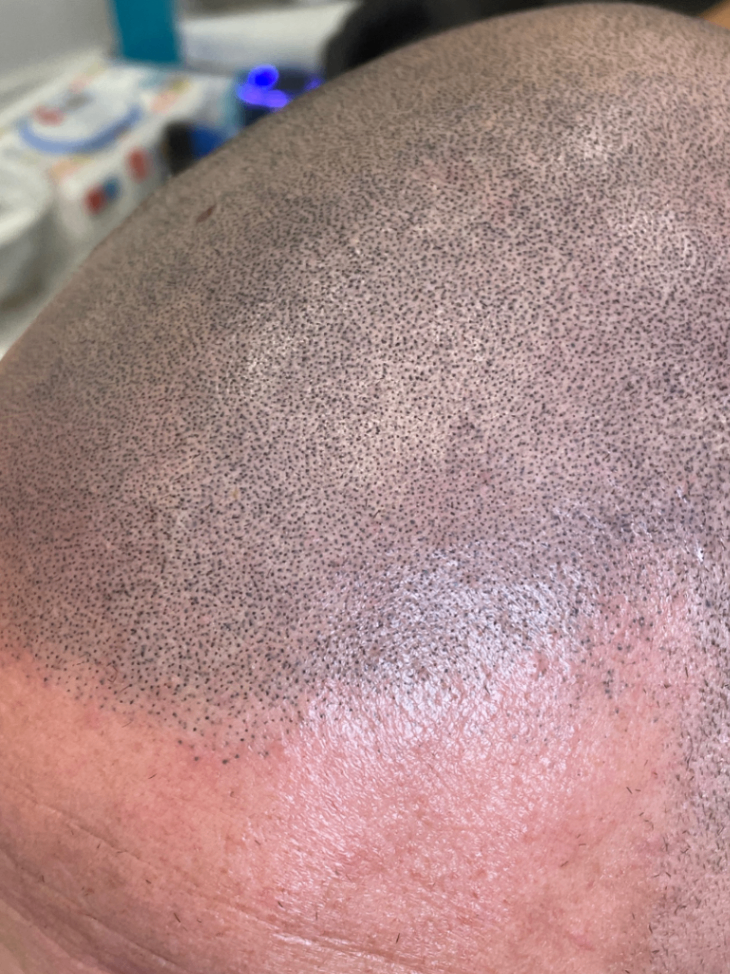 recupero tricopigmentazione effetto rasato seconda seduta di recupero