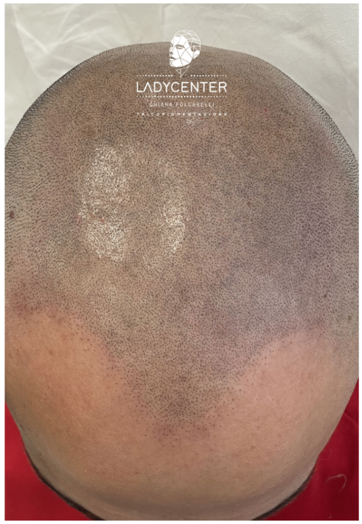 tricopigmentazione effetto rasato cuoio capelluto effetto densità