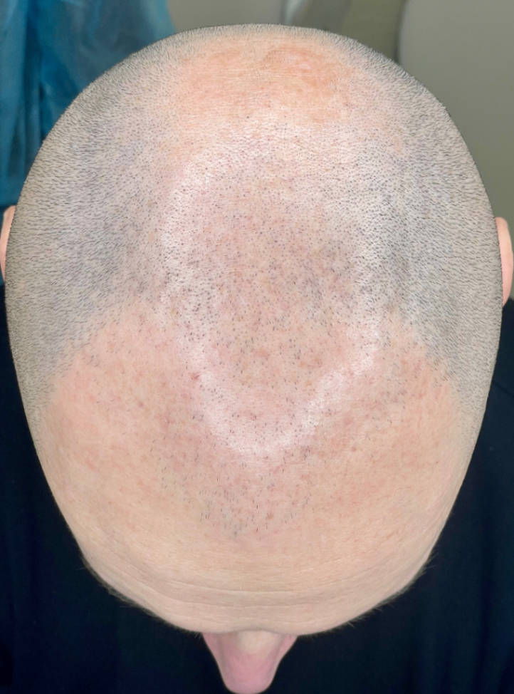 alopecia androgenetica tricopigmentazione