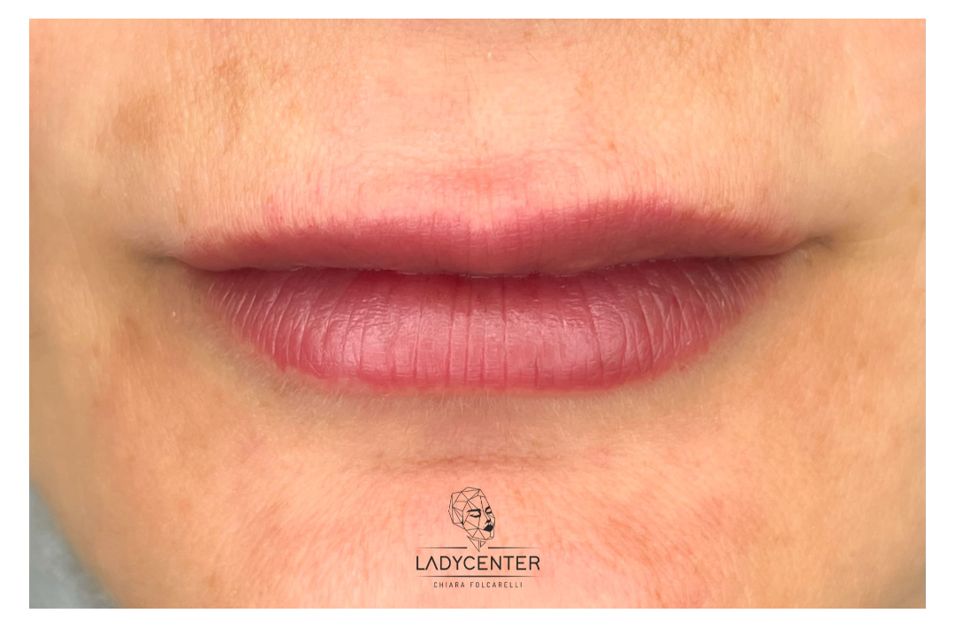 labbro asimmetrico correzione