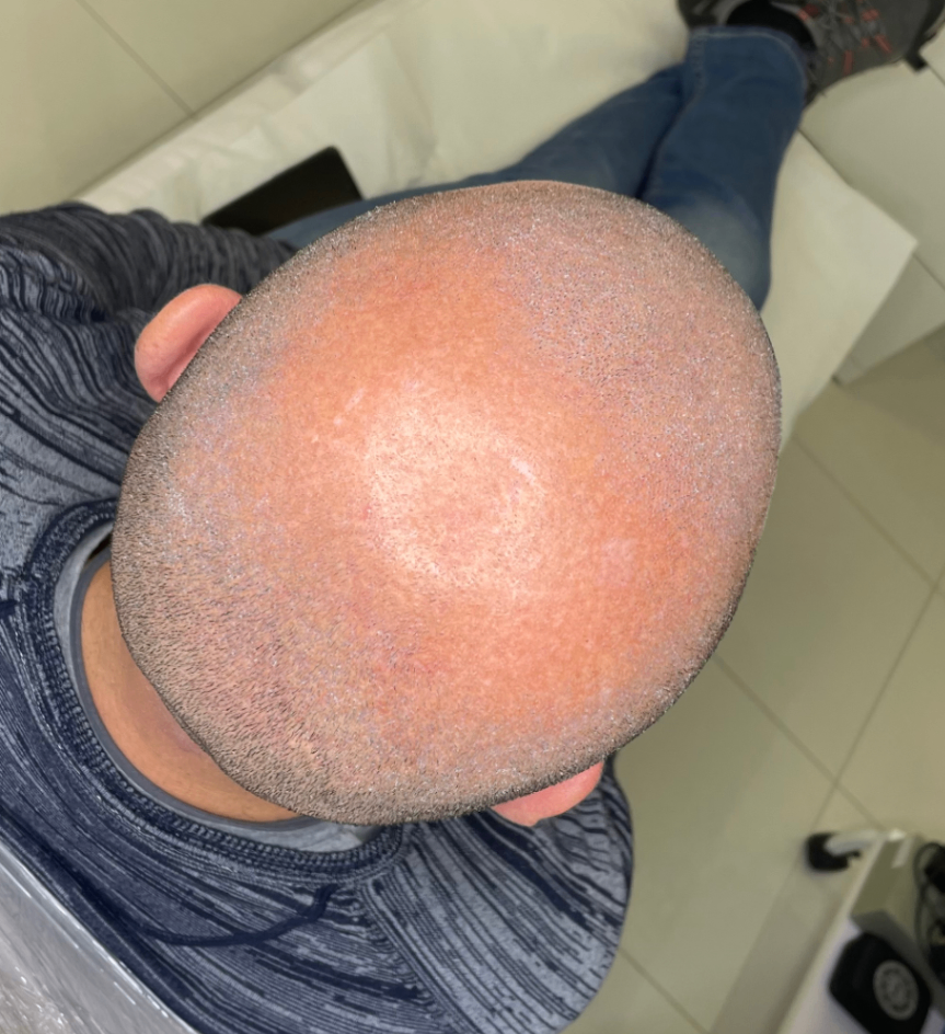 alopecia androgenetica vertex