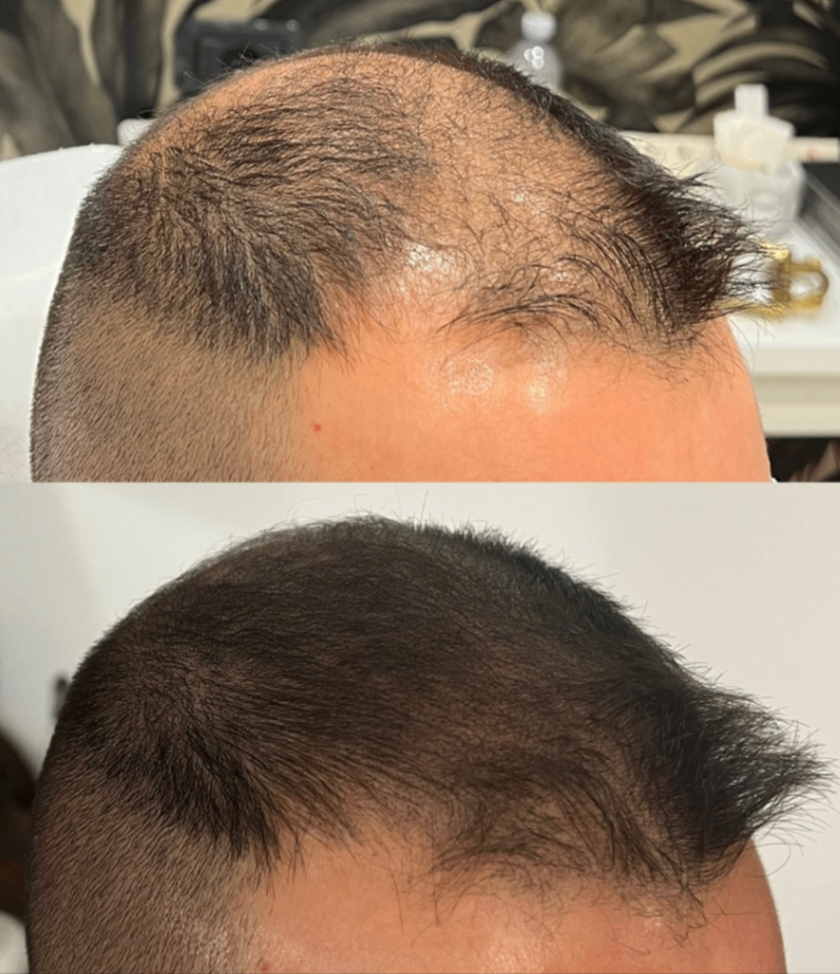 tricopigmentazione effetto densità