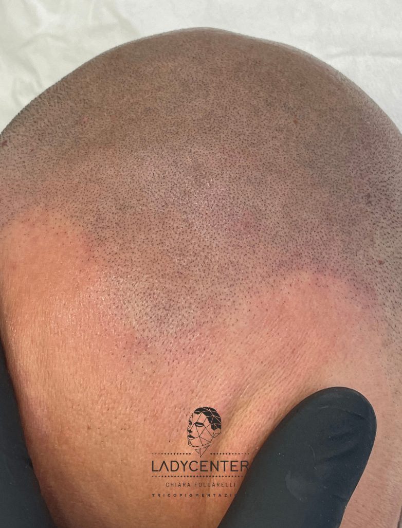 tricopigmentazione sfumanta