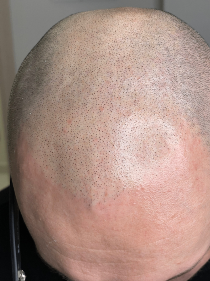 tricopigmentazione effetto rasato prima seduta