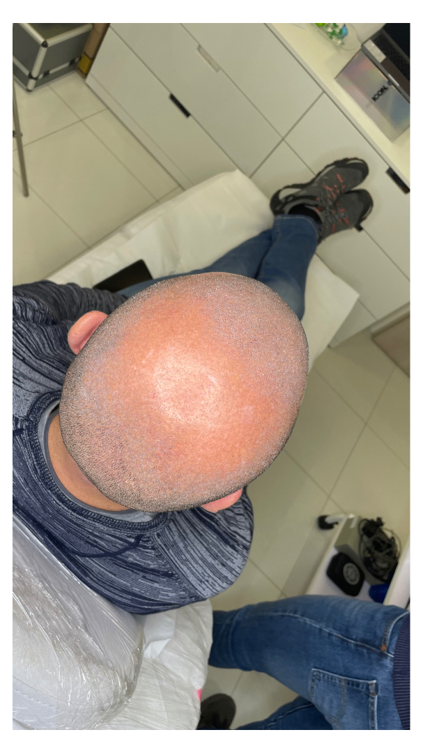 tricopigmentazione effetto rasato cuoio capelluto effetto densità