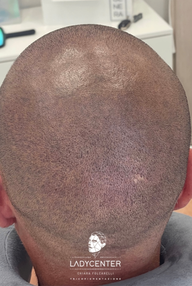 riempimento vertex-chierica con tricopigmentazione effetto rasato