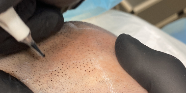 tricopigmentazione effetto rasto