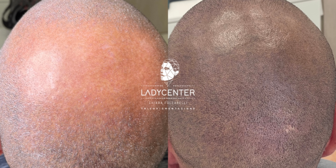 Rappresentazione visiva dell'articolo: FOTOGALLERY | Tricopigmentazione