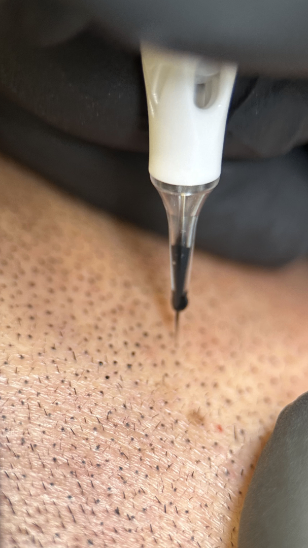 paura degli aghi tricopigmentazione