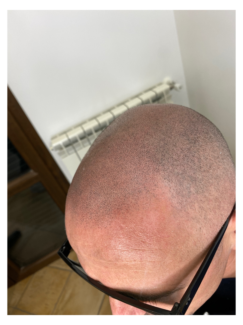 tricopigmentazione effetto rasato cuoio capelluto effetto densità
