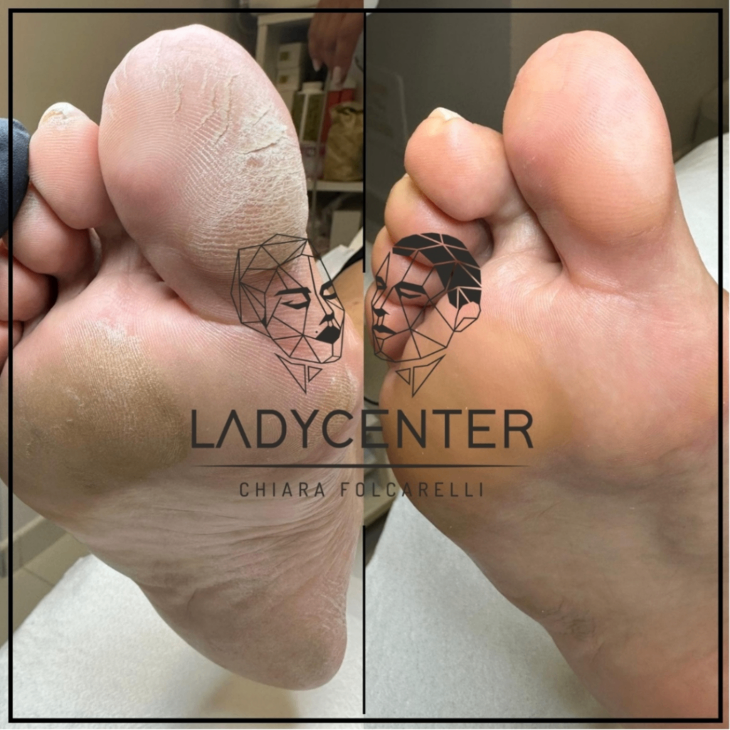pedicure senza lame