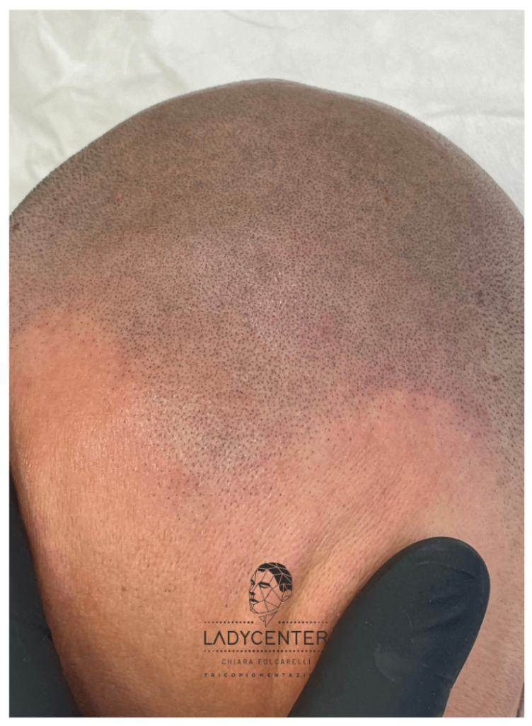 tricopigmentazione effetto rasato cuoio capelluto effetto densità