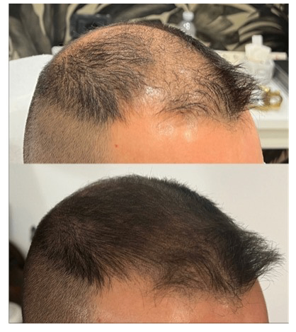 effetto densità tricopigmentazione cuoio capelluto