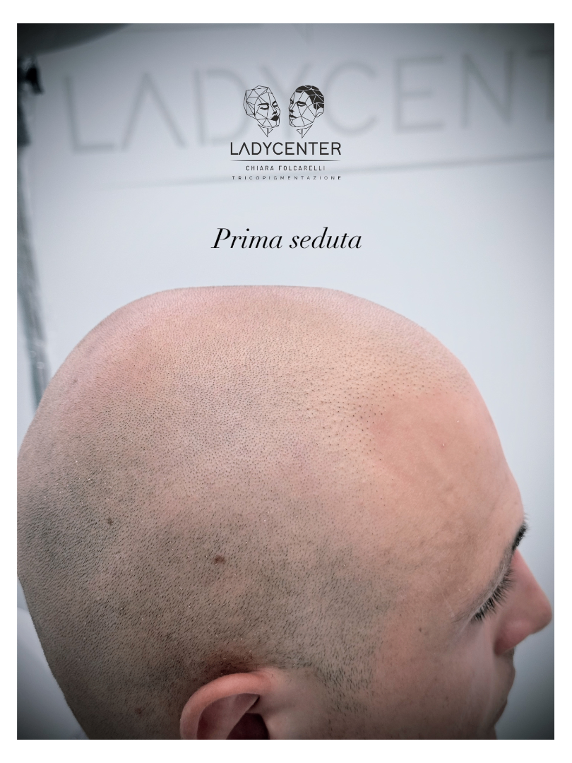 tricopigmentazione effetto rasato