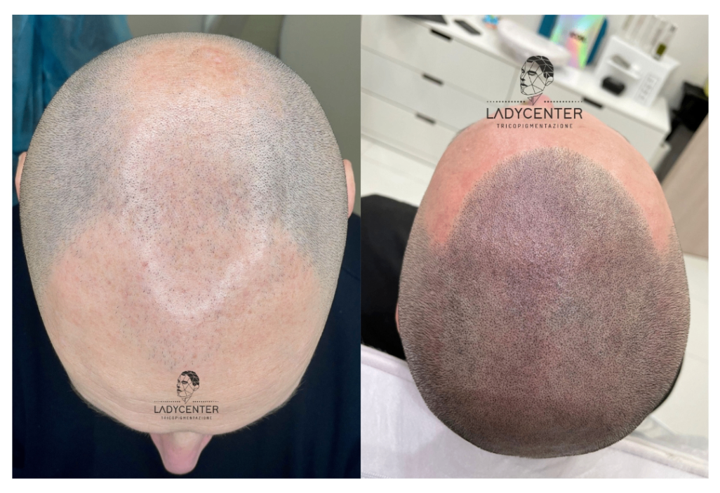 tricopigmentazione effetto rasato cuoio capelluto effetto densità