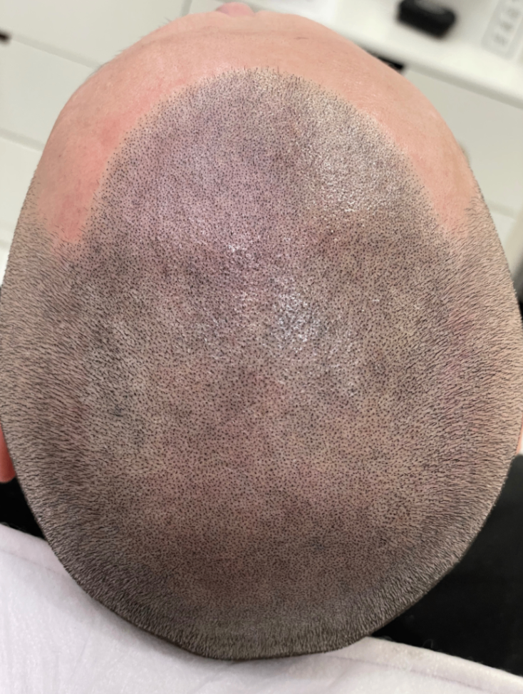 tricopigmentazione alopecia androgenetica 