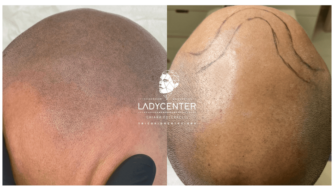tricopigmentazione cuoio capelluto effetto rasato