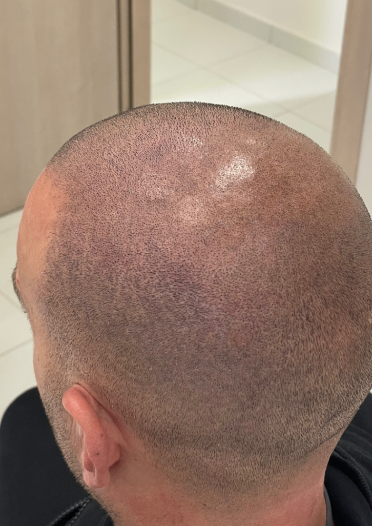 tricopigmentazione effetto rasato vertex seconda seduta