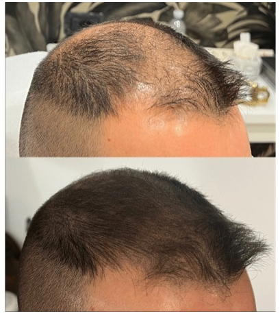 tricopigmentazione effetto rasato cuoio capelluto effetto densità