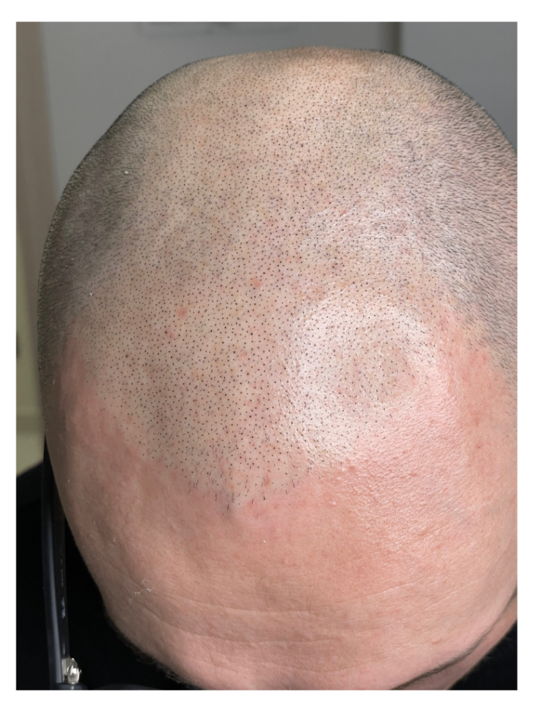tricopigmentazione effetto rasato cuoio capelluto effetto densità
