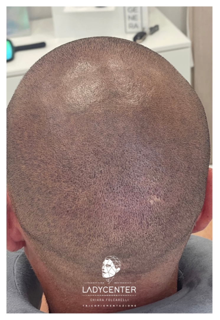 tricopigmentazione effetto rasato cuoio capelluto effetto densità