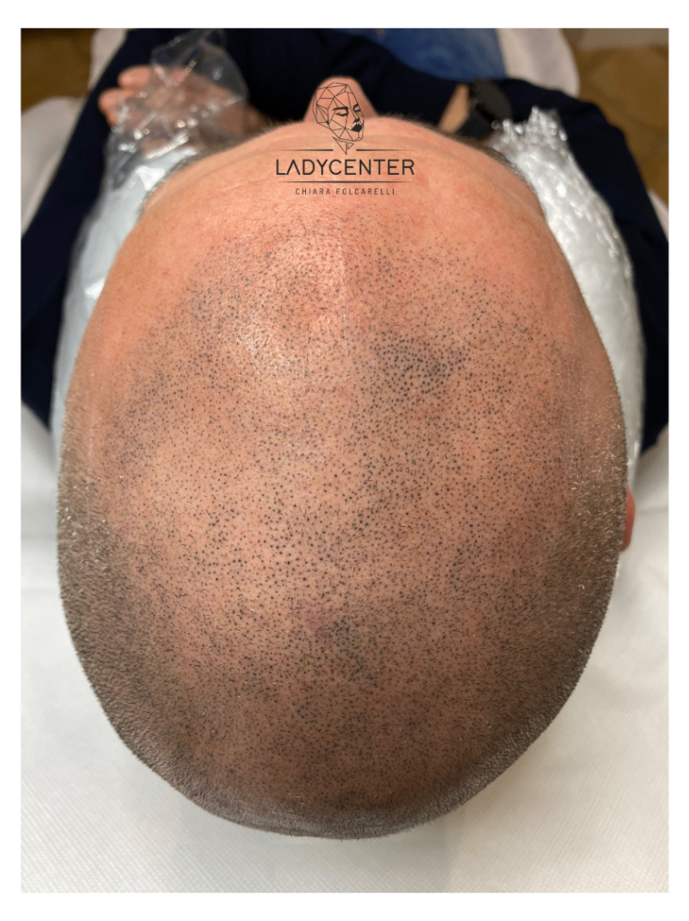 tricopigmentazione effetto rasato cuoio capelluto effetto densità