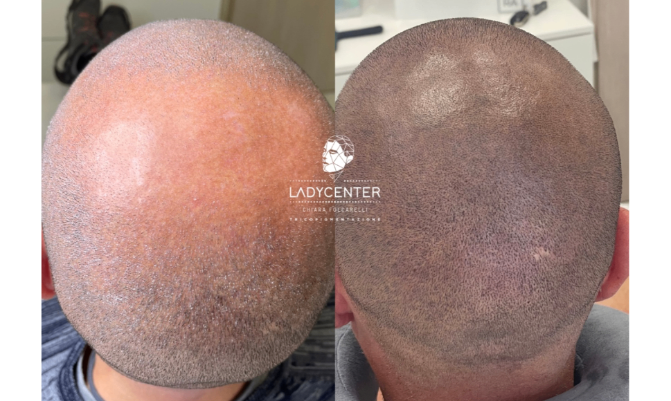 Tricopigmentazione di una alopecia areata nella zona del vertex